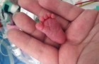 Elle naît avec une césarienne d'urgence et pèse seulement 225 grammes : voici l’incroyable histoire d’Emilia
