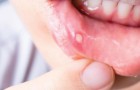 Was sind diese nervigen Bläschen im Mund und was bedeuten sie?