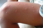 7 mogelijke redenen waarom muggen sommige mensen verkiezen boven andere
