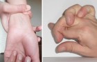 Se sai fare questo con le mani potresti avere la sindrome di Marfan