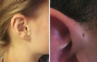 Some people have a tiny hole at the top of their outer ear and its origin is explained here 