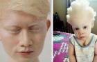 How are albino people in various parts of the world? Here is the answer!