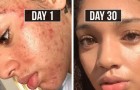 Guarisce l'acne con metodi naturali in 30 giorni: oggi il suo metodo aiuta migliaia di persone