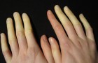 Mains et pieds froids, qui changent de couleur : le syndrome de Raynaud est répandu, mais peu le reconnaissent