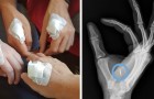 En Suède, de plus en plus de personnes se font implanter une puce dans la main : voici à quoi ça sert