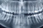 Volgens onderzoekers kan er een verband zijn tussen de ziekte van Alzheimer en een bacterie die verantwoordelijk is voor ontstoken tandvlees