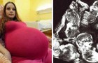Eine Frau wird bei ihrer rekordverdächtigen Geburt von Fünflingen von 40 Ärzten unterstützt
