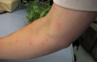 Waarom bijten muggen jou meer dan iemand anders? Hier zijn 7 redenen waarom je wordt gestoken