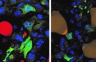 Um die Ausbreitung von Brustkrebs zu verhindern, verwandeln Wissenschaftler Brustzellen in Fett