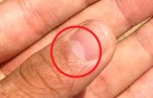 De witte halve manen op de nagels: wat is het en wat kunnen ze onthullen over onze gezondheidstoestand