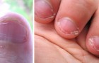 Een man heeft een potentieel dodelijke infectie opgelopen vanwege zijn gewoonte om op zijn nagels te bijten