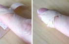 3 metodi efficaci per applicare i cerotti nel modo giusto su ogni tipo di ferita alle dita