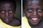 Abushe, the blue-eyed Ethiopian child: he is 8 years old and suffers from a rare syndrome that made him 