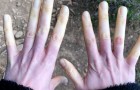 Se con il freddo inizia a manifestarsi un intenso pallore sulle dita delle mani, potreste avere la sindrome di Raynaud