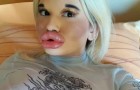 Twenty-two year old has her lips augmented in an extreme way, but wants them even bigger: on social networks they call her 