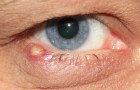 Ein Grieskorn ist eine lästige Schwellung, die unsere Augenlider betreffen kann: einige der Hauptursachen