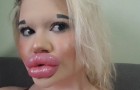 Deze jonge vrouw heeft $5.000 uitgegeven om haar lippen te vergroten, maar ze wil nog niet stoppen