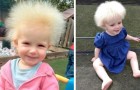 Den här flickan har uncomable hair syndrome: 