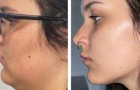 Plastische chirurgie: 16 foto's van mensen die hun toevlucht hebben genomen tot cosmetische chirurgie en enthousiast zijn over de resultaten