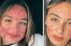 De retar henne för att hon har acne - en tonåring berättar sin historia på sociala medier för att utmana mobbarna