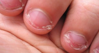Mangiarsi le unghie è un vizio molto diffuso e può rivelare alcuni tratti della personalità