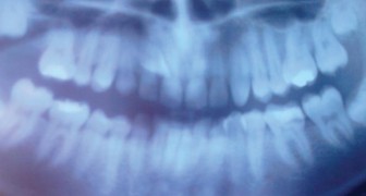 Vertigini, mal di schiena e problemi di postura: E se fosse colpa dei denti storti?