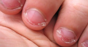 Att bita på naglarna är en mycket utbredd ovana och kan avslöja vissa delar av en människas personlighet