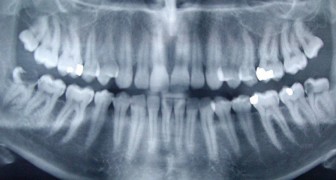 Volgens onderzoekers kan er een verband zijn tussen de ziekte van Alzheimer en een bacterie die verantwoordelijk is voor ontstoken tandvlees