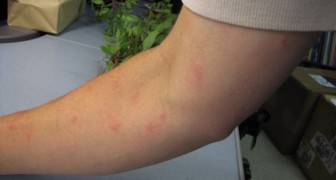 Why do mosquitoes bite you more than anyone else? Here are seven reasons why you are being targeted