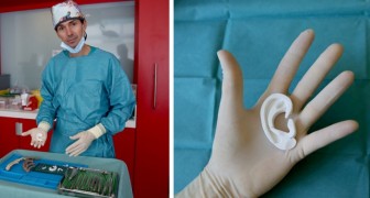 Firenze: all'ospedale Meyer viene ricostruito l'orecchio di un bimbo di 13 anni grazie alla tecnologia 3D