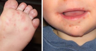Syndrome pieds-mains-bouche : la pathologie qui peut toucher les enfants et qui se combat avec l'hygiène