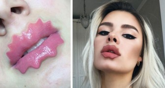 Die neueste verrückte Mode in der plastischen Chirurgie: Lippen wie die von Cartoon-Bösewichten haben