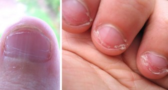 Un homme a contracté une infection potentiellement mortelle à cause de son habitude de se ronger les ongles