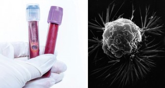 Un esame del sangue sarebbe in grado di diagnosticare il cancro fino a 4 anni prima dai sintomi: lo studio