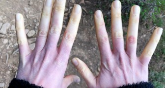 If your fingers start to turn pale when cold, you may have Raynaud's syndrome