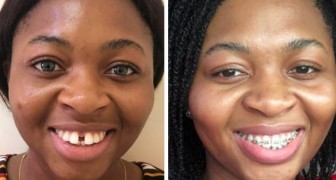 15 photos de personnes qui ont réussi à obtenir le sourire qu'elles souhaitaient avec un appareil dentaire