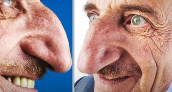 Die größte Nase der Welt gehört einem 71-jährigen Mann: Sie misst fast 9 cm