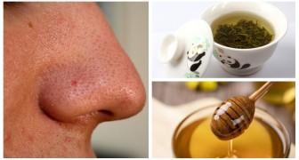 Brufoli e punti neri: prova questi trattamenti naturali da preparare in casa contro l'acne