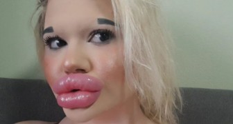 Diese junge Frau hat $5000 ausgegeben, um ihre Lippen zu vergrößern, aber sie will noch nicht aufhören