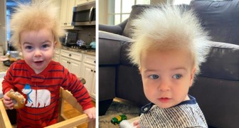 Este niño tiene el síndrome del cabello despeinado: ¡Pensábamos que le estaba saliendo el cabello rizado!