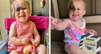 Meisje werd geboren met een zeldzame vlek op haar gezicht, haar moeder laat haar foto's zien om haar schoonheid en uniekheid te delen