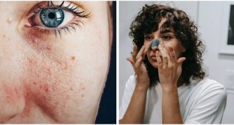 Pores dilatés : 9 conseils utiles pour en réduire les dimensions et améliorer l'aspect de la peau