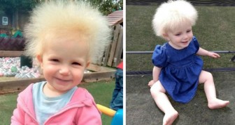 Cette petite est atteinte du syndrome des cheveux indomptables : jusqu'à 12 mois, ils étaient normaux mais ensuite ils sont devenus hirsutes