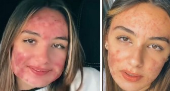 De retar henne för att hon har acne - en tonåring berättar sin historia på sociala medier för att utmana mobbarna