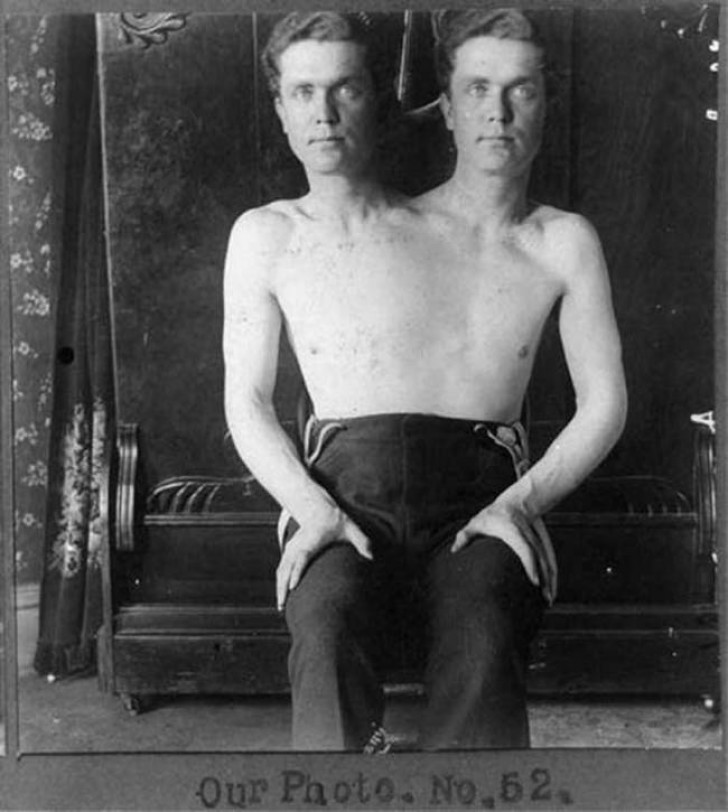 L’homme aux deux têtes : un exemple de bicéphalie, le résultat d’une séparation manquée de jumeaux monozygotes.