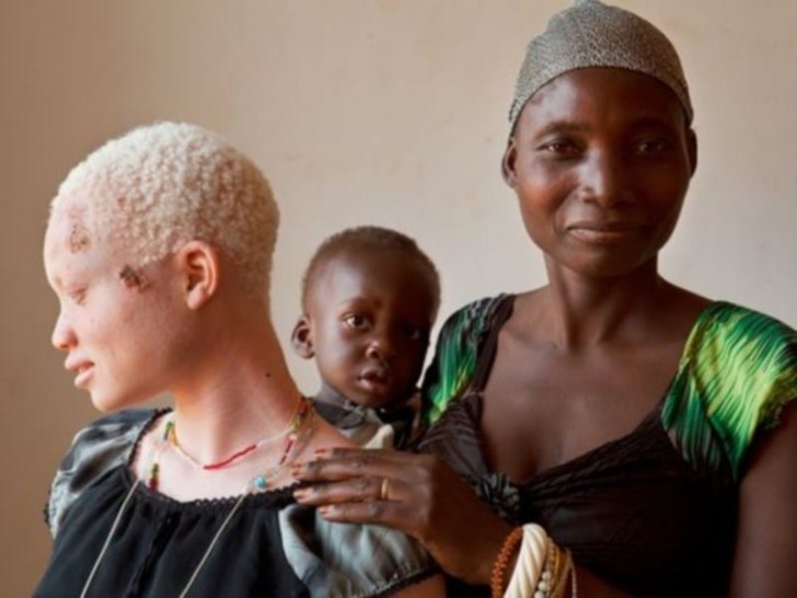 Oggi in Tanzania le pratiche di stregoneria sono vietate, ma la fine di questa orribile caccia all'albino è ancora lontana.