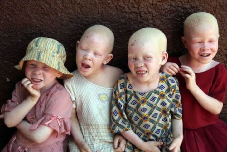 Vittime dei riti di stregoneria sono molto spesso gli albini, i bambini soprattutto: l'albinismo è una malattia genetica ereditaria che consiste nella mancanza di pigmentazione degli occhi, della pelle e dei capelli.
