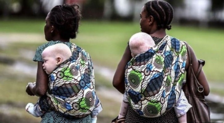 In Tanzania il tasso di nascite di albini è sopra la media, 1 bambino su 1400, a causa della frequente unione tra consanguinei. Nel resto del mondo la proporzione si attesta ad 1 su 20.000.