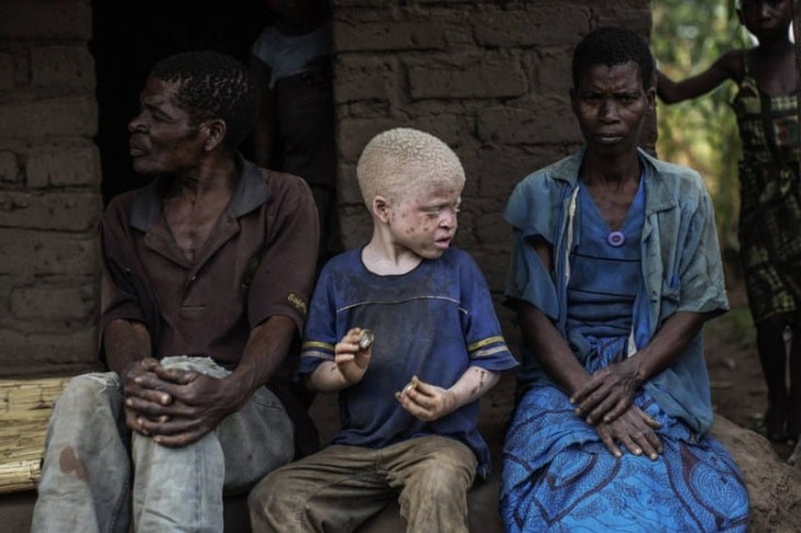 Una secolare credenza africana vede negli albini spiriti maligni che attirano energie negative sulla famiglia che li accoglie e su chiunque abbia contatti con loro.