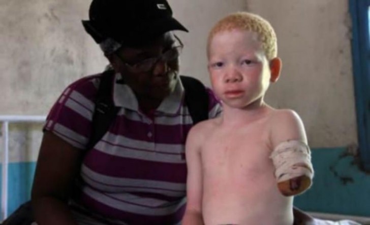 Attorno a tale credenza è nato il terribile commercio di amuleti di albini: i bambini vengono privati di arti, capelli e altre parti del corpo con cui vengono confezionati talismani portafortuna.